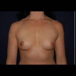 Breast Enlargement Before & After Patient #1001