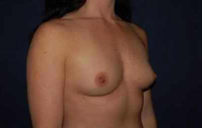 Breast Enlargement Before & After Patient #1001
