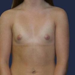 Breast Enlargement Before & After Patient #1009