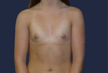 Breast Enlargement Before & After Patient #1009
