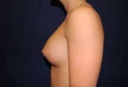 Breast Enlargement Before & After Patient #1009