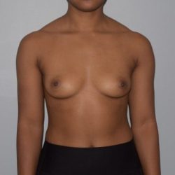 Breast Enlargement Before & After Patient #1012