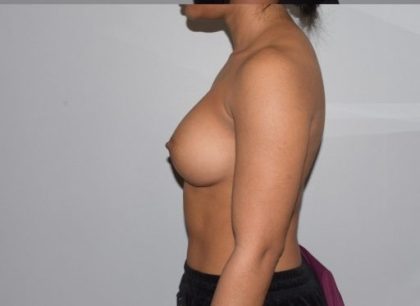 Breast Enlargement Before & After Patient #1012