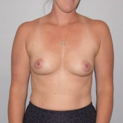 Breast Enlargement Before & After Patient #1016
