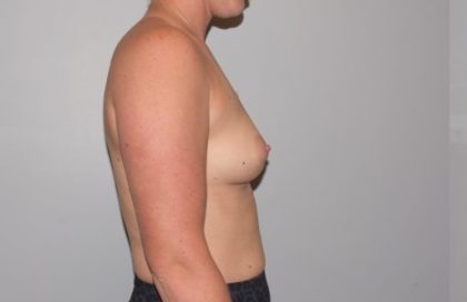 Breast Enlargement Before & After Patient #1016