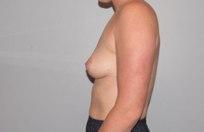 Breast Enlargement Before & After Patient #1016