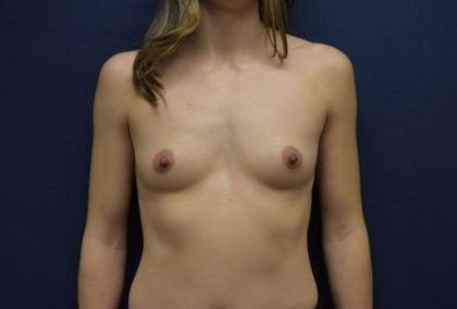 Breast Enlargement Before & After Patient #1019