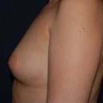 Breast Enlargement Before & After Patient #1027