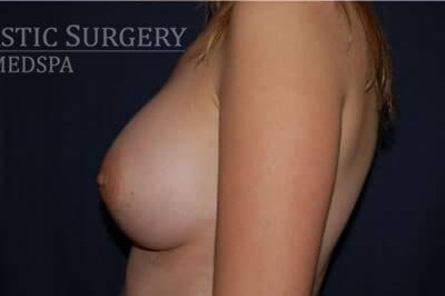 Breast Enlargement Before & After Patient #1031