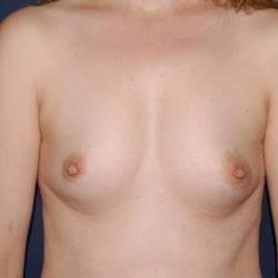 Breast Enlargement Before & After Patient #1031