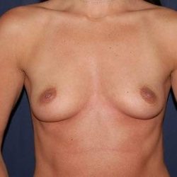 Breast Enlargement Before & After Patient #1035