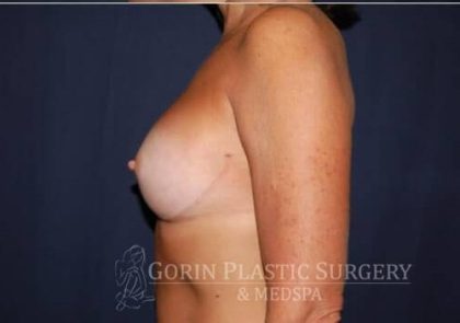 Breast Enlargement Before & After Patient #1039