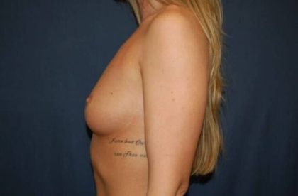 Breast Enlargement Before & After Patient #1043