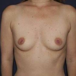 Breast Enlargement Before & After Patient #1047