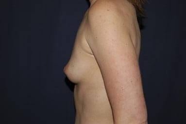 Breast Enlargement Before & After Patient #1047