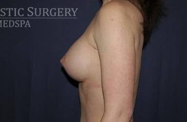 Breast Enlargement Before & After Patient #1047