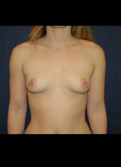 Breast Enlargement Before & After Patient #1051