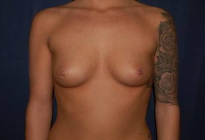 Breast Enlargement Before & After Patient #1055