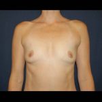 Breast Enlargement Before & After Patient #1058