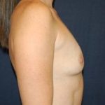 Breast Enlargement Before & After Patient #1058