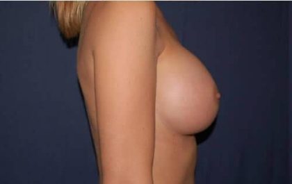 Breast Enlargement Before & After Patient #1061