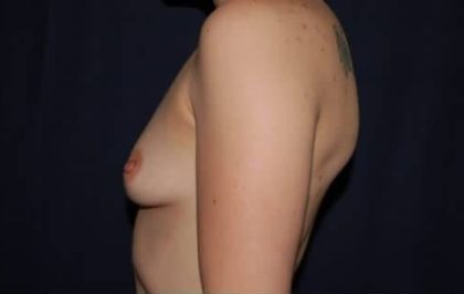 Breast Enlargement Before & After Patient #1065