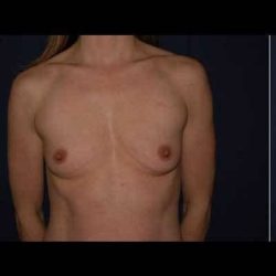 Breast Enlargement Before & After Patient #1073