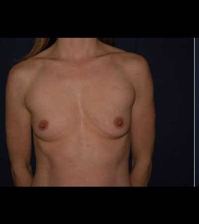 Breast Enlargement Before & After Patient #1073