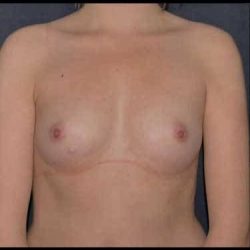Breast Enlargement Before & After Patient #1077