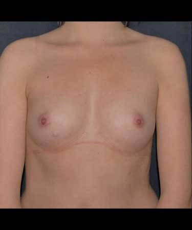 Breast Enlargement Before & After Patient #1077