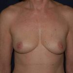 Breast Enlargement Before & After Patient #1080