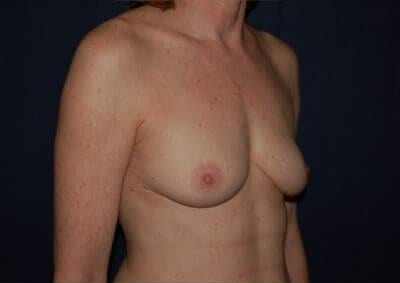 Breast Enlargement Before & After Patient #1080