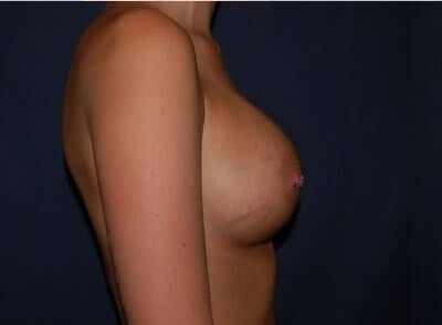 Breast Enlargement Before & After Patient #1084