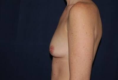 Breast Enlargement Before & After Patient #1087