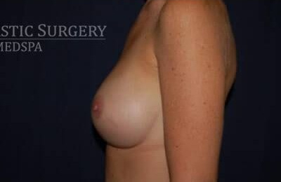 Breast Enlargement Before & After Patient #1087