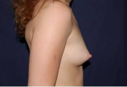 Breast Enlargement Before & After Patient #1091