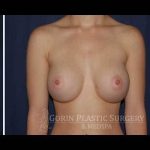 Breast Enlargement Before & After Patient #1091