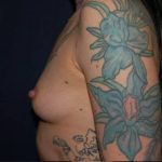 Breast Enlargement Before & After Patient #1095