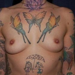 Breast Enlargement Before & After Patient #1095