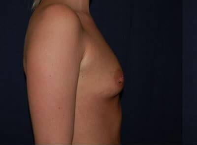 Breast Enlargement Before & After Patient #1099