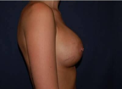 Breast Enlargement Before & After Patient #1099