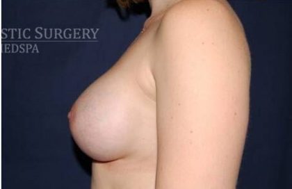 Breast Enlargement Before & After Patient #1107