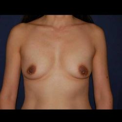 Breast Enlargement Before & After Patient #1111