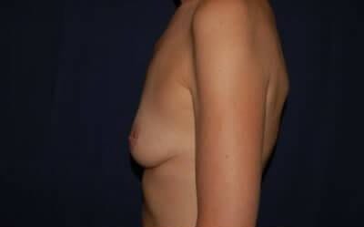 Breast Enlargement Before & After Patient #1115