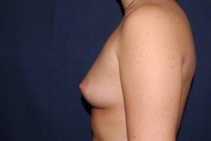 Breast Enlargement Before & After Patient #1122