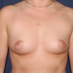 Breast Enlargement Before & After Patient #1122