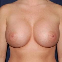 Breast Enlargement Before & After Patient #1122