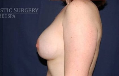 Breast Enlargement Before & After Patient #1126
