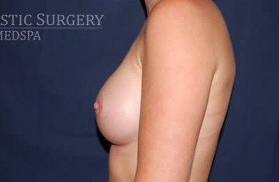 Breast Enlargement Before & After Patient #1130