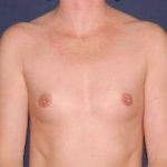 Breast Enlargement Before & After Patient #1130